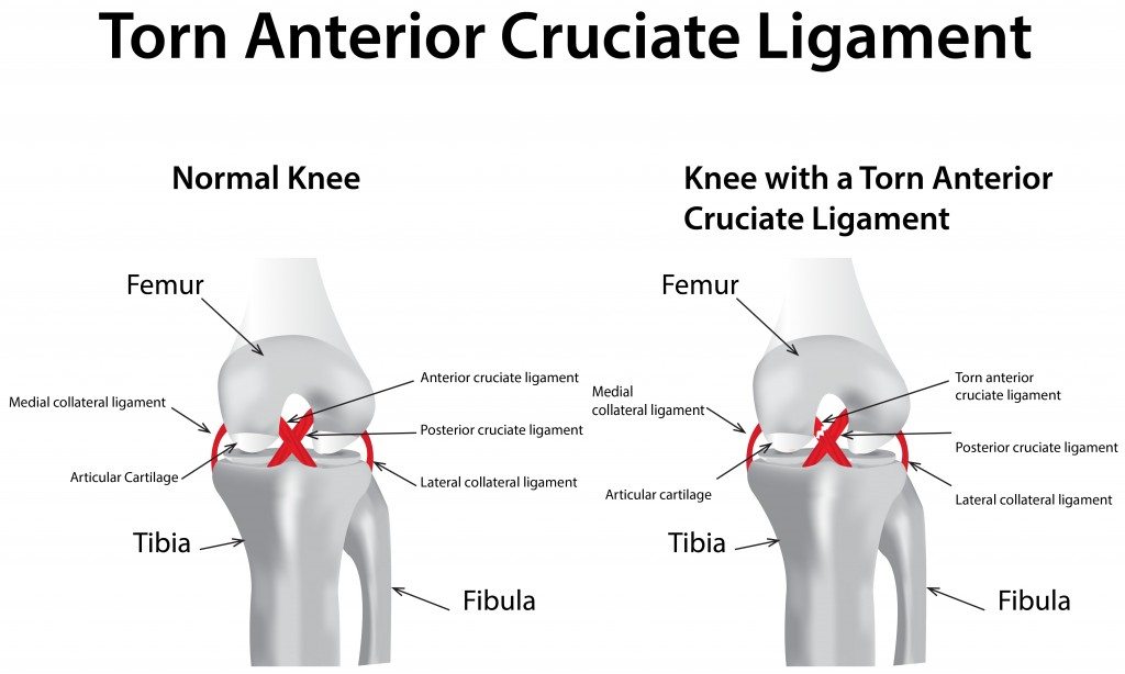 Top 5 Knee Rehab Exercises After ACL Injury – Trusted Tips from Physica Knoxfield