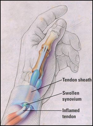 DeQuervains Tendonitis