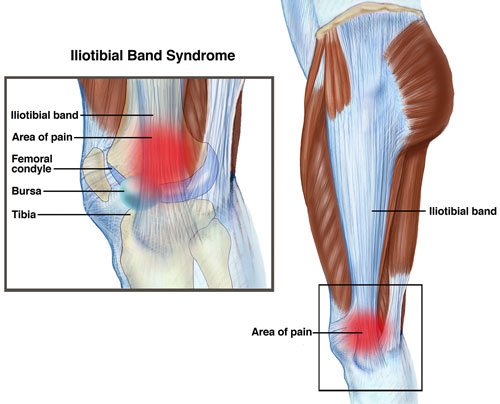 ITB- Iliotibial Band