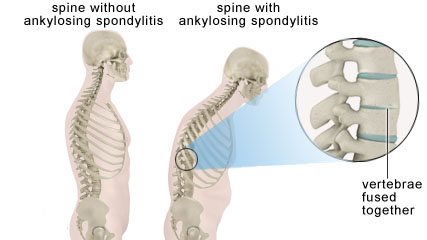 Spondylo What ???