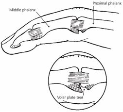 volar plate pic