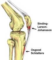 Sinding-Larsen-Johansson Syndrome