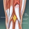 hamstring tear2