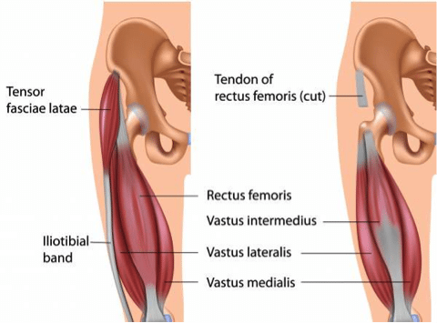 Quadriceps strain