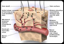 shingles