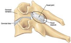 Facet Joint Dysfunction