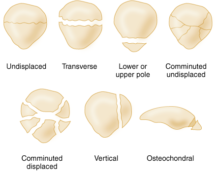 patella fractures