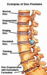 Spinal degeneration