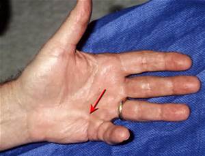 Dupuytren`s Contracture