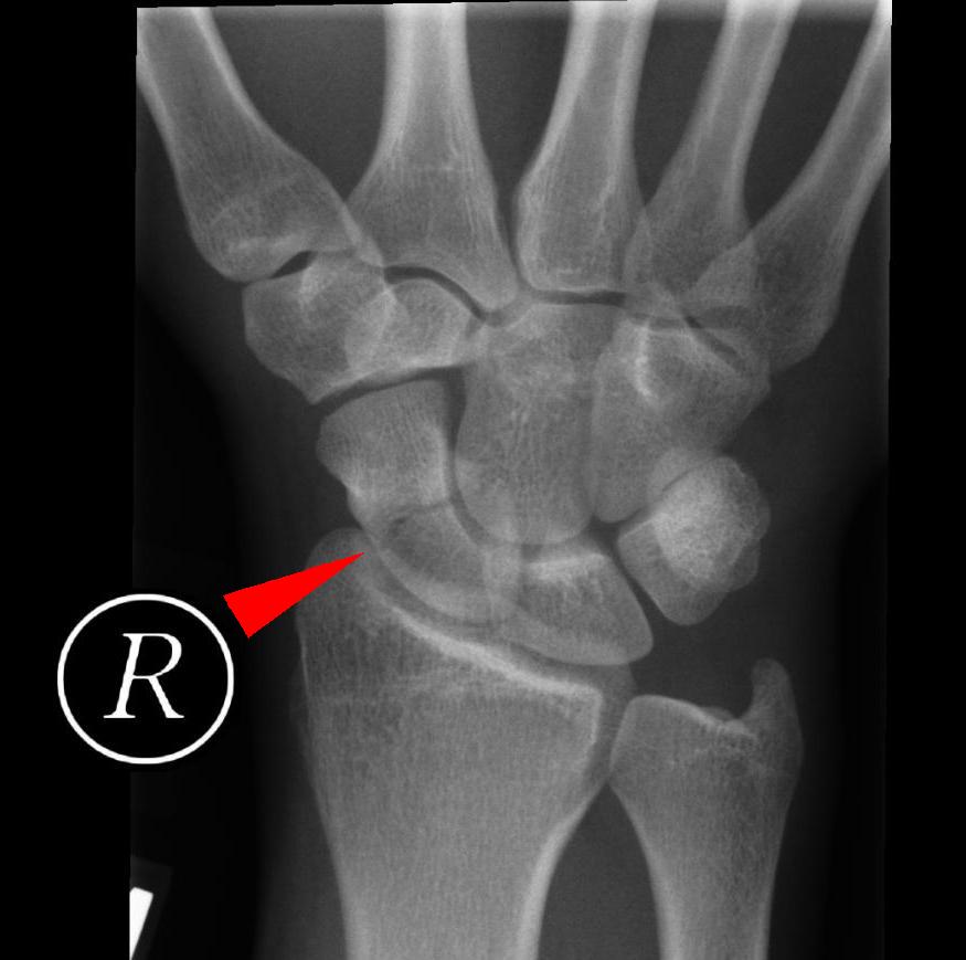 scaphoid fracture