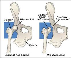 Hip pain in children