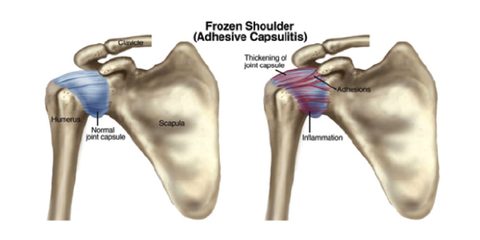 Frozen Shoulder (Adhesive Capsulitis)