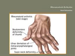 rheumatoid hand