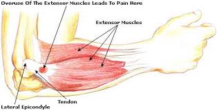 Tennis Elbow (lateral epicondylalgia)