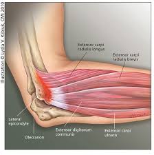 tennis elbow