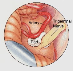 trigeminal2.png