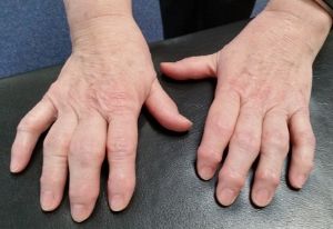 Rheumatoid Arthritis