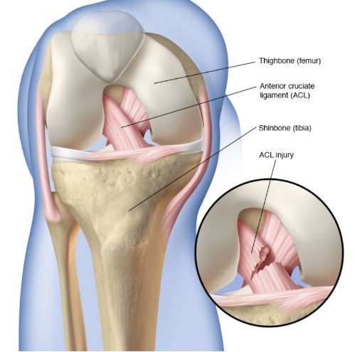 ACL Injury: Do I need surgery?