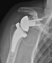 What is a reverse shoulder replacement