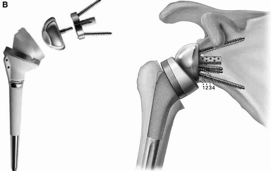 reverse shoulder replacement surgery 1