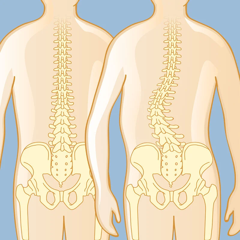 scoliosis normal v curve lg